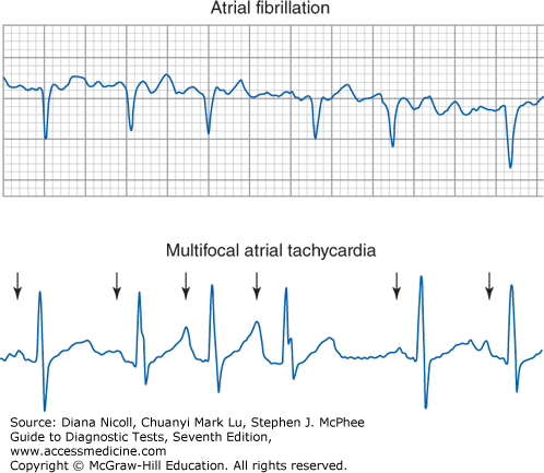 Basic Electrocardiography Guide To Diagnostic Tests